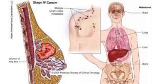 tumor payudara